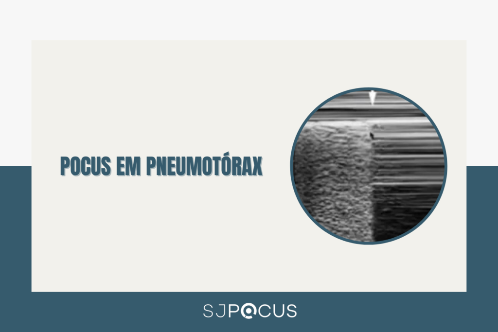 POCUS EM PNEUMOTÓRAX SJPOCUS