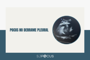 POCUS NO DERRAME PLEURAL SJPOCUS