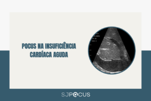 POCUS NA INSUFICIÊNCIA CARDÍACA AGUDA SJPOCUS